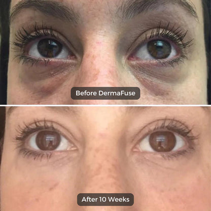 Skinwise™ Micro needle Eye patches